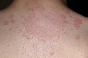 Ringworm fungal infection
