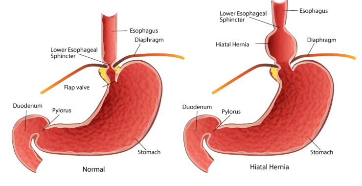 hiatal hernia