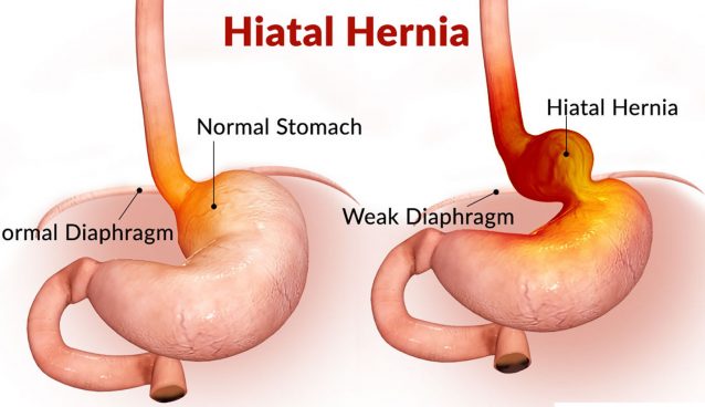 hiatal hernia