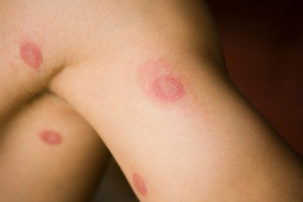ringworm