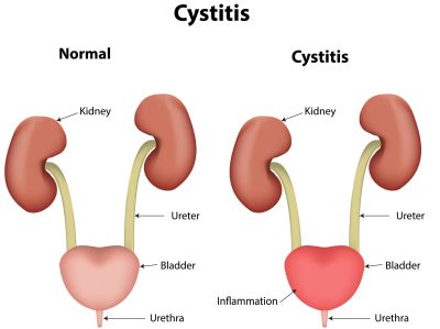 cystitis urinary bladder tract
