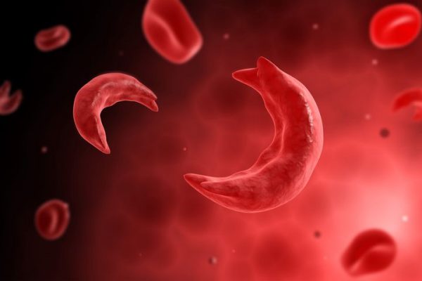 Sickle cell