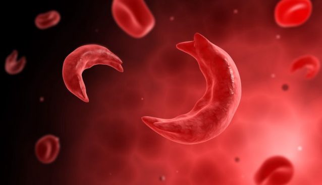 Sickle cell