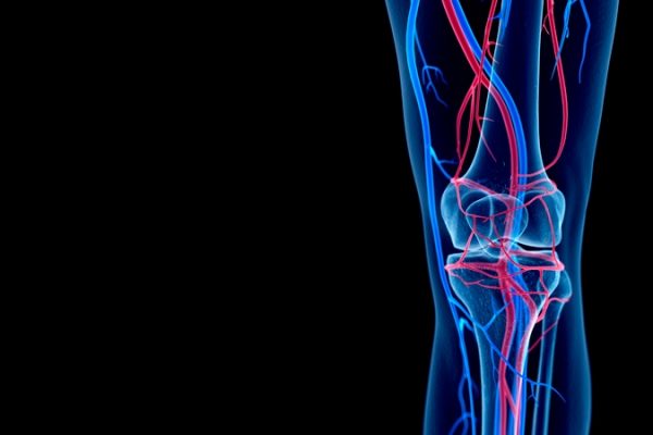 Varicose veins