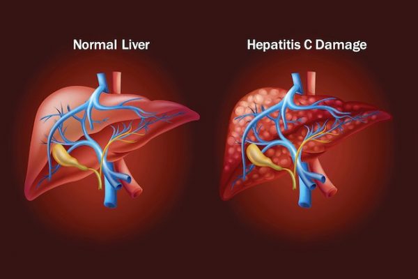 hepatitis c
