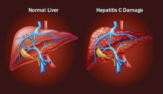 hepatitis c
