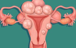 Exercise and Uterine Fibroids