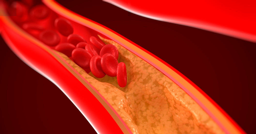 7 Essential Tips for Maintaining Healthy Arteries