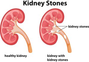 Diagram of kidney stones