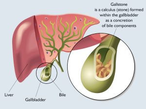 Gallbladder showing gallstones