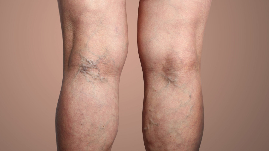 Varicose vein