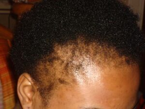 Traction alopecia (hair loss)