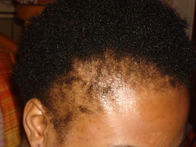 Traction alopecia (hair loss)