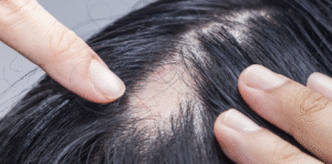 Traction alopecia (hair loss)