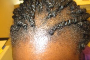 Traction alopecia (hair loss)