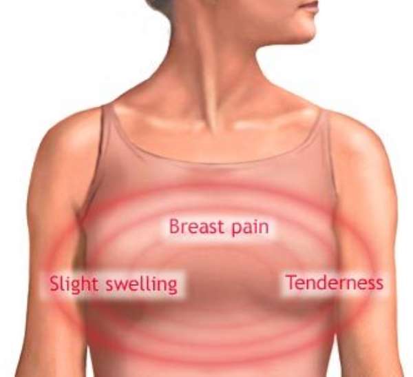 Breast swelling