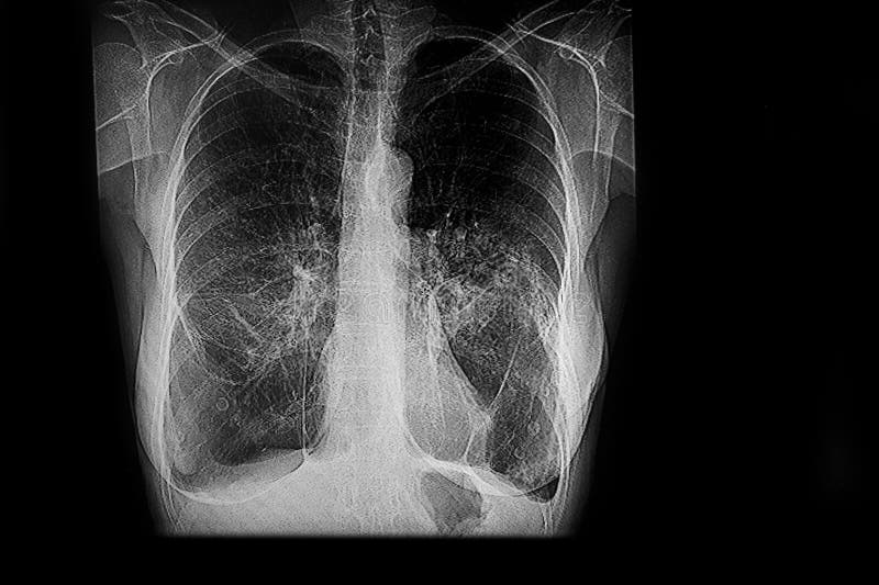 Medical x-ray image showing pulmonary emphysema - lower respiratory tract infection - small pleural effusion